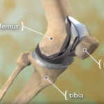 Are you legally allowed to drive after you have recovered from a total knee replacement surgery?